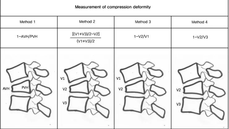 Fig. 1. Measurement of compressive deformity by 4 different methods. 