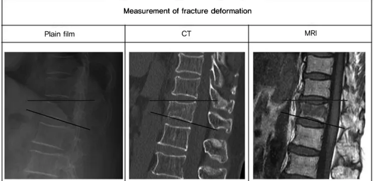 Fig. 2. Measurement of kyphotic deformity by 2 different methods(Cobb’s  angle, local kyphotic angle).