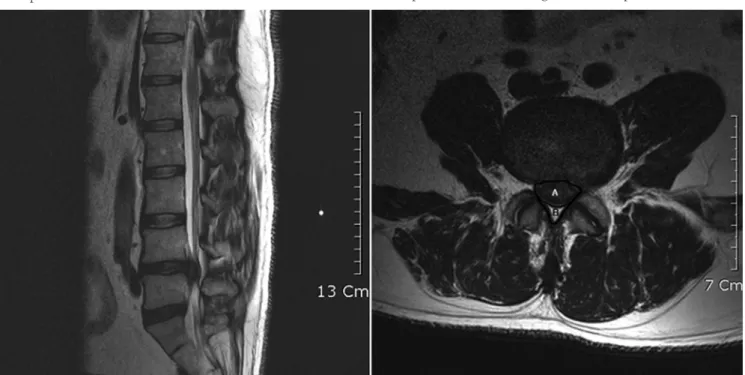 Fig. 1. MRI finding of disc herniation and the method of canal compromised area.