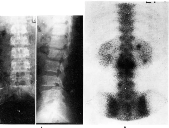 Fig.  1.  39.year.old  male  with  abnormal  hot  area  in  L2  compression  fracture  site