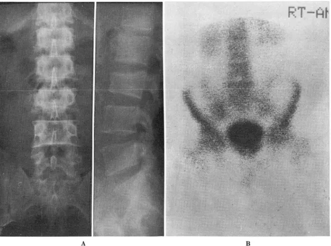 Table 3.  Bone scan findings in  thoracic spines 
