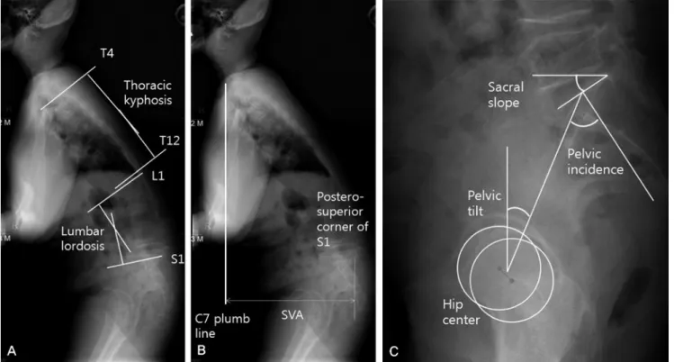 Fig. 4. Thoracic kyphotic angle is measured from T4 to T12, lumbar lordotic angle L1 to S1(A)