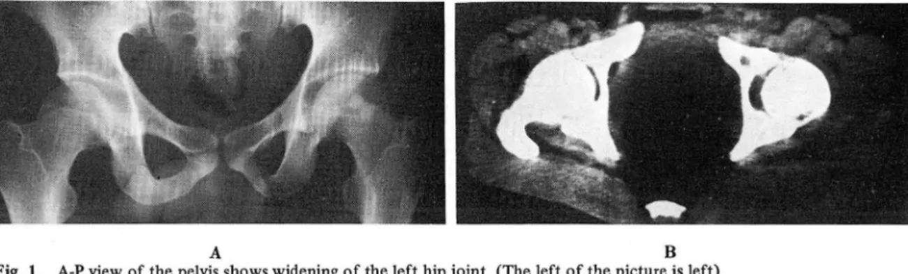 Fig.  1.  A-P view  of the pelvis shows widening of the left hip joint. (The left of the picture is left)