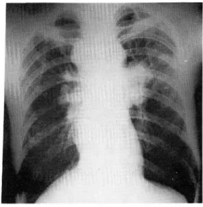 Fig.  4.  Peripheral mass. 