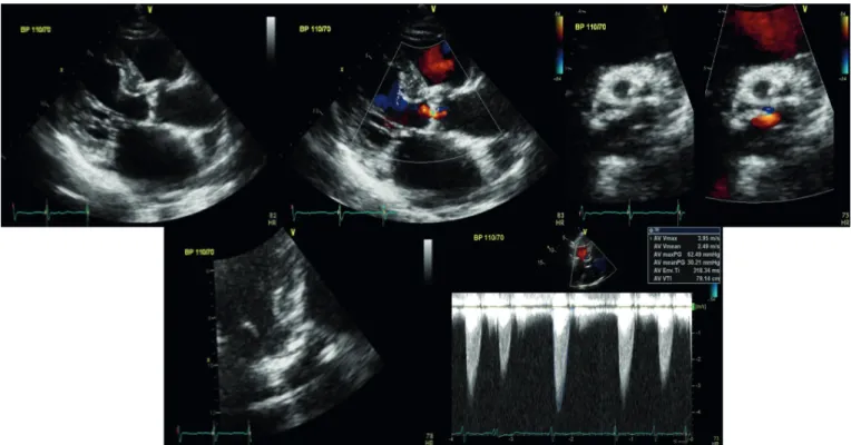 Fig. 1. Transthoracic echocardiogram showed severe AS (AVA: 0.96 cm 2  by continuity equation) with peak/mean pressure gradient (64/33 mmHg)