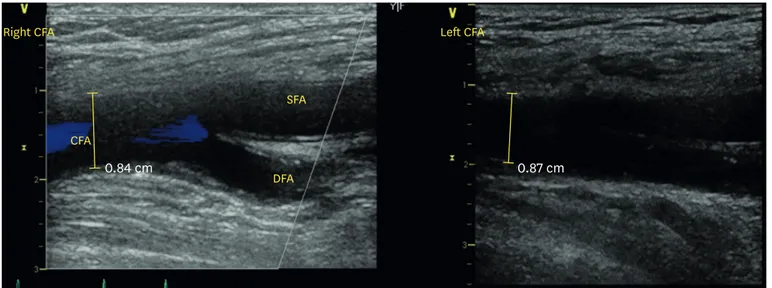 Fig. 4. Vascular ultrasound showed acceptable access site of left external iliac artery