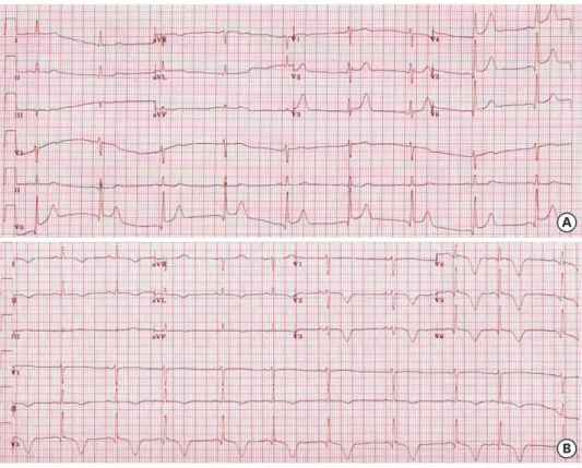Fig. 3. (A) One month later, ECG showed ST elevation and tall T waves in V2 to V6. (B) The next day, the ECG  showed deep T wave inversions in the precordial leads
