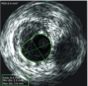Fig. 7. Post-PCI IVUS showed that minimal stent area was 8.4 mm 2  with decreased plaque burden in the target lesion