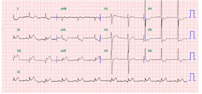 Fig.  1.  Initial  EKG  in  Case  1.  There  is  ST  elevation  in  lead  II,  III,  aVF  with  reciprocal  change  in  V4-6