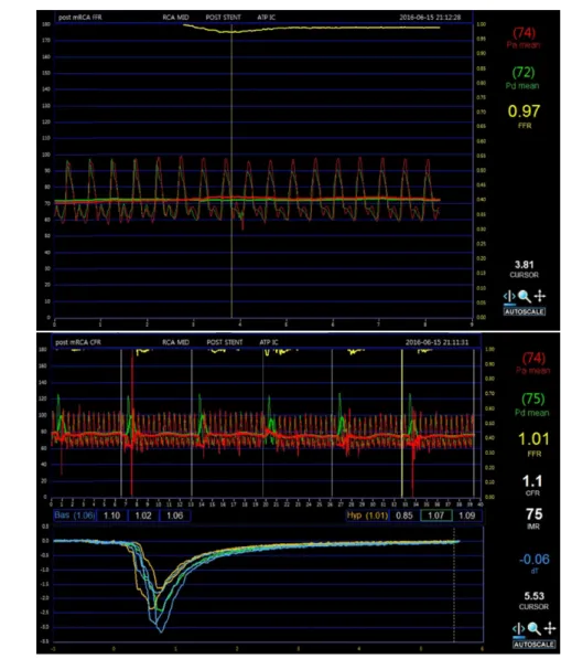 Fig. 4. Post-PCI Physiologic assessment in culprit vessel in Case 1. CFR was depressed to 1.1 and IMR was elevated up to 75 U.