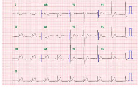 Fig.  6.  Initial  EKG  in  Case  2.  There  is  ST  elevation  in  II,  III,  aVF  with  reciprocal  changes  with  V2-4.