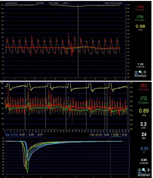 Fig. 9. Post-PCI Comprehensive Physiologic Assessment in Culprit Vessel in Case 2. CFR was 2.2 and IMR was 24 U.