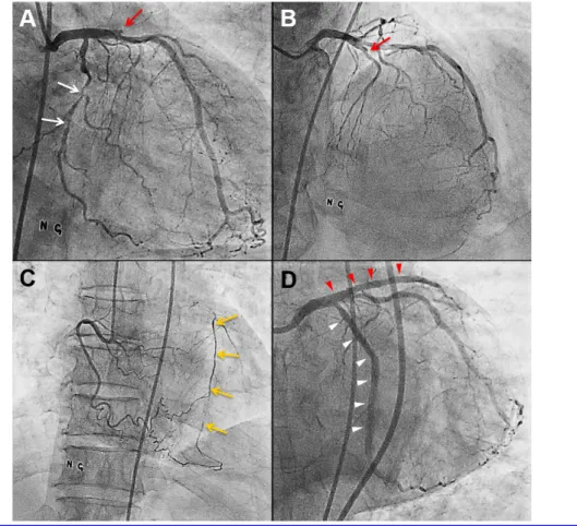 Fig. 2. Coronary angiography at initial presentation. (A and B) Total occlusion of proximal left anterior descending artery (LAD) (red arrow) and significant stenosis in left circumflex artery (LCX) (white arrows), (C) Right coronary artery with collateral