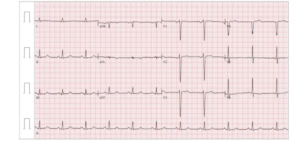 Fig.  3.  Patient’s  electrocardiogram  at  second  presentation.