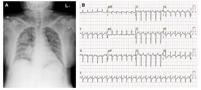 Fig. 1. Chest X-ray and electrocardiogram of our patient at the time of emergency department visit
