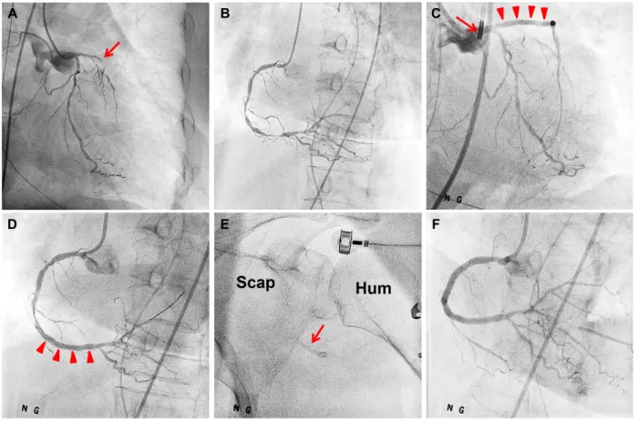 Fig. 2. Coronary angiographic findings and PCI procedures. (A) An occluded proximal LAD (arrow) and moderate-degree stenosis of the LCX,  (B) Multiple severe stenosis of RCA, (C) Successful LAD revascularization with a drug-eluting stent (arrow heads) with