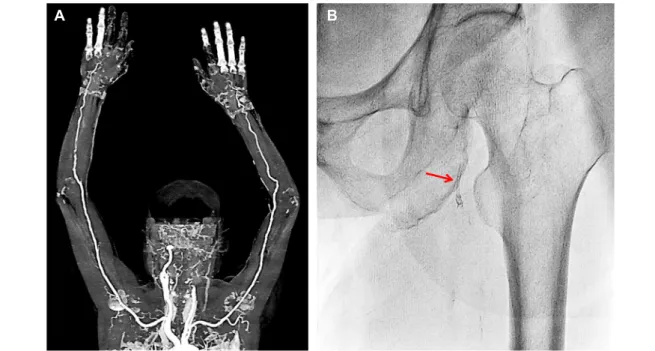 Fig. 3. Tracking the lost coronary stent. (A) Computed tomography angiography of the upper extremities shows no evidence of  the  lost  stent,  (B)  Fluoroscopic  exploration  shows  the  lost  stent  in  the  right  superficial  femoral  artery  (arrow).