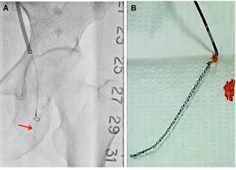 Fig. 4. Retrieval of the lost coronary stent. (A) The stent (arrow) was caught by a snare device, and (B) successfully retrieved stent  by  using  the  snare.