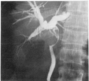 Fig. 2.  Percutaneous  transhepatic  cholangiogram  reveals 