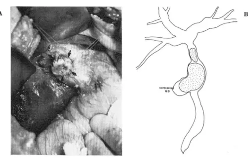 Fig.  3.  A)  Contracted gaIlbladder was excised 
