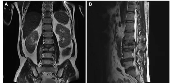 Fig.  1.  Spinal  magnetic  resonanace  imaging  at  coming  to  the  orthopedics.  Images  show  burst  fracture  of  the  3rd  lumbar.