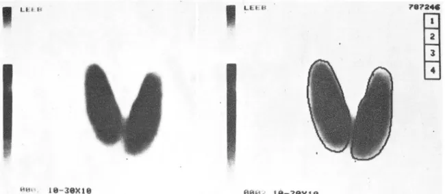 Fig.  1.  Drawing  of Area  of interest (A.O .I)  by light pen. 