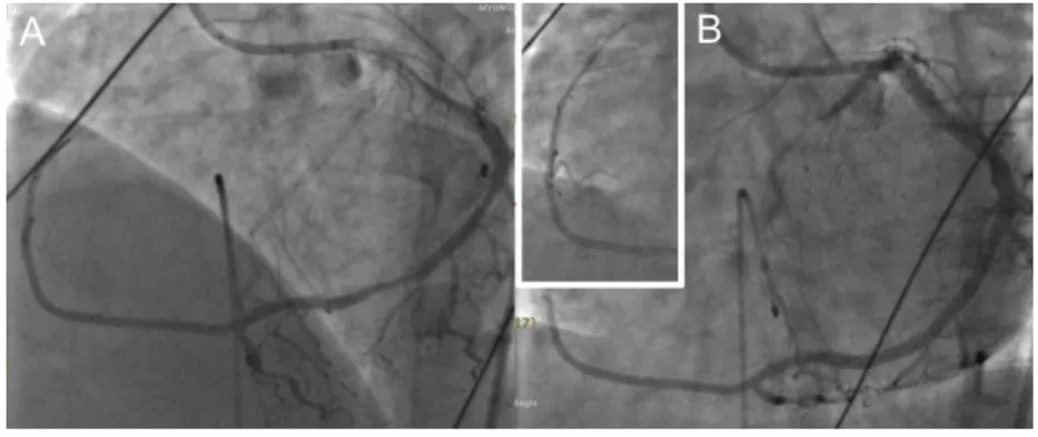 Fig.  4.  Followed  computed  tomography  coronary  angio- angio-graphy  3  months  after  procedure  confirmed  that  the  RCA  originated  from  distal  LCX  proper  artery.