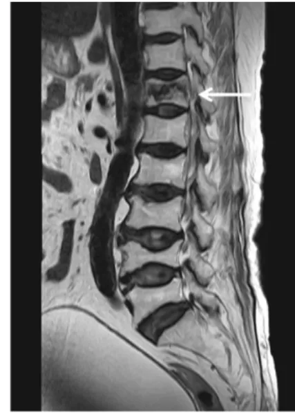 Fig.  3.  A  sagittal  view  of  the  spine  before  kyphoplasty. 