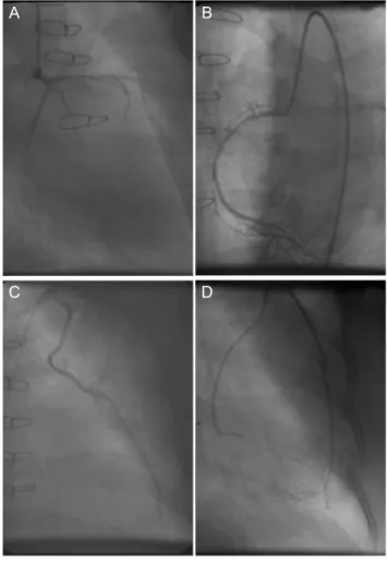 Fig. 2. Left subclavian artery angiography. (A) Left subclavian artery angiogram shows a tight stenosis in the ostium without contrast  reflux  into  the  ascending  aorta,  (B)  Successful  stenting  to  the  ostium  shows  good  patency  to  subclavian  