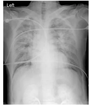 Fig. 2. Initial chest X-ray showed bilateral pulmonary edema.