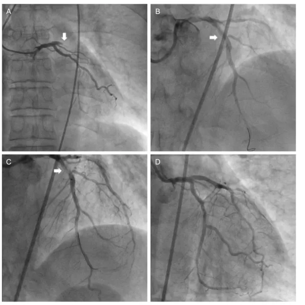 Fig. 3. (A) Left anterior oblique (LAO) projection with caudal  angulation of selective left coronary angiogram showed the total  occlusion  with  thrombus  in  the  proximal  part  of  left  anterior  descending  artery  (arrows),  (B)  LAO  projection  w