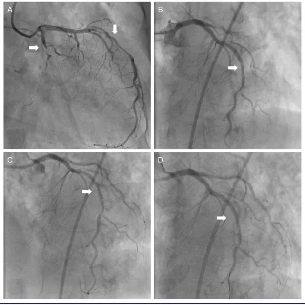Fig.  4.  (A)  Right  anterior  oblique  (RAO)  projection  with  caudal  angulation  of  selective  left  coronary  angiogram  showed the long segmental concentric stenosis in proximal to middle LAD and total occlusion in proximal LCX (arrows), (B) LAO pr