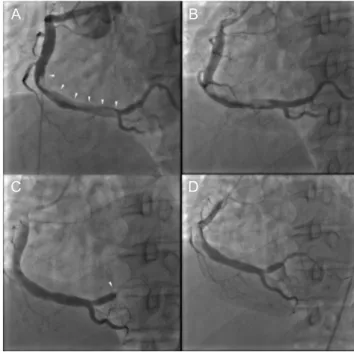 Fig. 1. Past coronary angiographic findings 16 months before the  current  admission.  (A)  A  cut-off  sign  by  thrombotic  occlusion in the ostium of the postero-lateral branch (white arrowhead),  (B)  Percutaneous  mechanical  thrombosuction was perfor