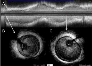Fig.  3.  Intravascular  ultrasound  (IVUS)  findings  after  me- me-chanical thrombosuctionon hospital day 2