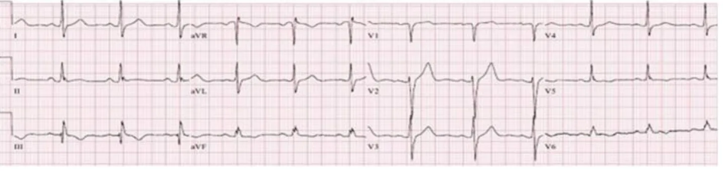 Fig.  1.  Twelve-lead  electrocardiogram  showed  normal  sinus  rhythm  and  T-wave  inversion  in  leads  III,  aVF  and  V5-V6.