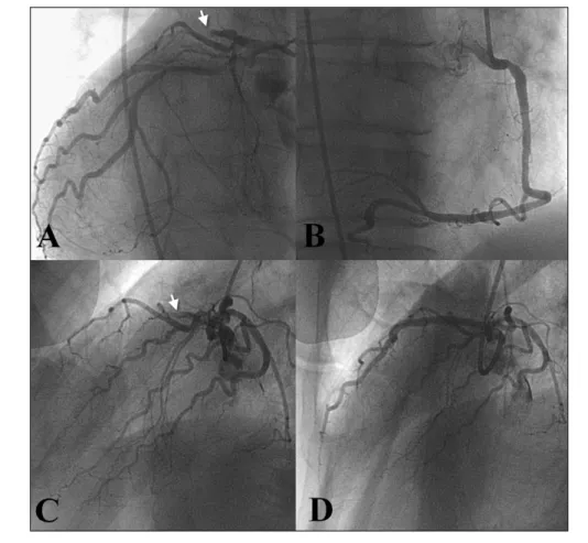 Fig. 4. Left coronary angiogram demonstrates thrombotic total occlusion proximal left anterior descending coronary artery (Arrow  heads,  A:  right  anterior  oblique  caudal  view,  C:  left  anterior  oblique  cranial  view)