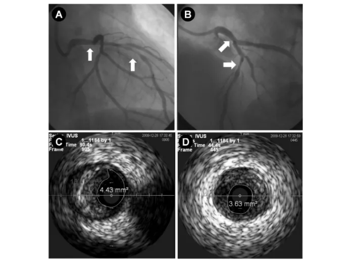 Fig.  2.  A  &amp;  B,  His  coronary  angiogram  showed  significant  stenosis  in  the  distal  LMCA  to  the  proximal  LAD  with  some filling defect suggesting intracoronary thrombus (A; RAO cranial view, B; LAO cranial view); C &amp; D, Pre-PCI intra