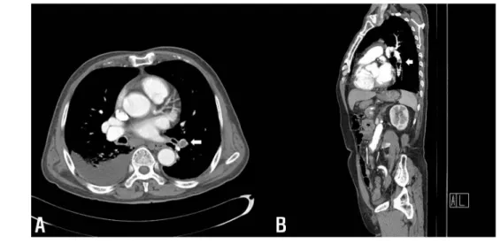 Fig.  2.  Filling  defects  in  segmental  pulmonary  arteries  in  left  lower  lobe  (A  and  B:  white  arrow).