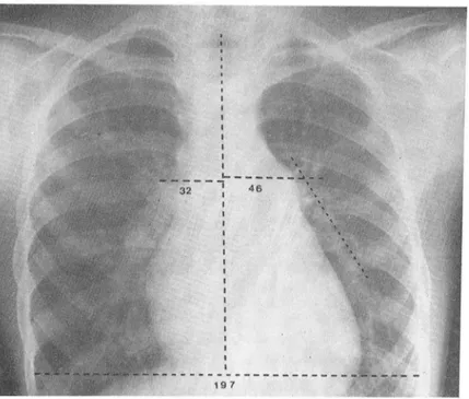 Fig. 2.  Patient  with  ventricular  septal  defect  and  pulmonary  artery  pressure  of68 mmHg 