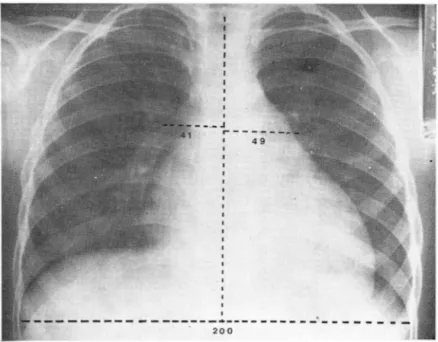 Fig.  3.  Patient  with  patent  ductus  arteriosus  and  severe  pulmonary  arterial  hypertension of 80mmHg