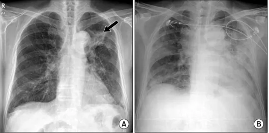 Fig. 2.  (A)  Known  lung  cancer  mass  (arrow)  in  the  left  upper  lobe.  (B)  Multifocal  patchy   in-filtrative  lesions  in  both  lung  fields.