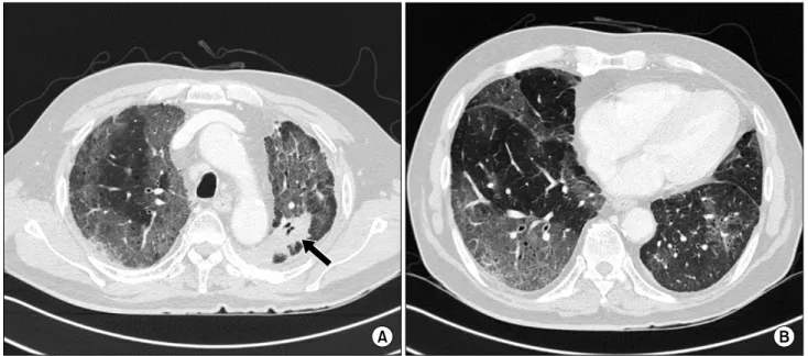 Fig. 3.  (A,  B)  Computed  tomography  scans  show  multifocal  non-segmental  ground  glass  opacities  with  partial  interlobular  septal  thickening  in  both  whole  lung  fields,  which  are  more  predominant  in  the  peripheral  zone
