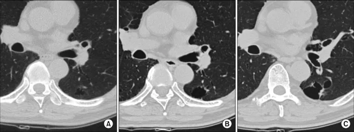 Fig. 1.  The  initial  chest  computed  tomography  (CT)  scan  showed  a  thin-walled  cystic  lesion  in  the  left  lower  lobe
