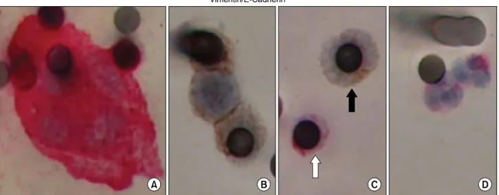 Fig. 2.  Epithelial  (E-cadherin)  and  mesenchymal  (vimentin)  markers  in  circulating  tumor  microemboli  (CTM)  and  circulating  tumor  cells  (CTCs)  profiled  by  dual-color  IHC