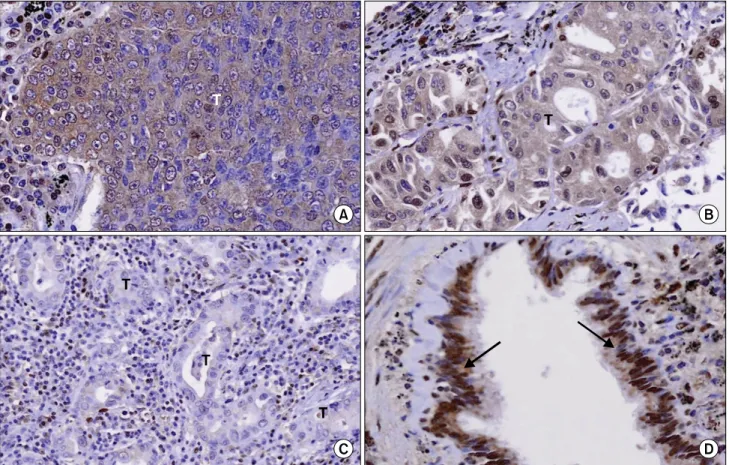 Fig. 2.  Visualization  of  DOK2  expression  in  lung  cancer  tissues  by  immunohistochemistry