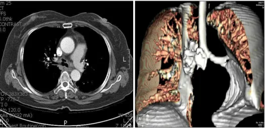 Fig. 1. Chest  CT  finding  of  bron- bron-cho-mediastinal  fistula  after   photo-dynamic  therapy  and  concurrent  chemoradiation  therapy.