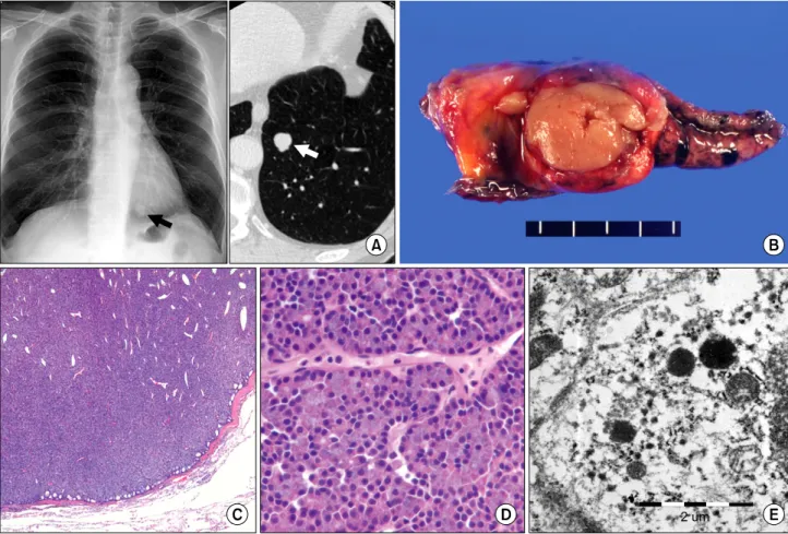 Fig. 1.  (A)  The  chest  PA  X-ray  and  CT  show  an  ovoid  pulmonary  nodule  (1.3  cm,  arrows)  in  the  left  lower  lobe  of  lung