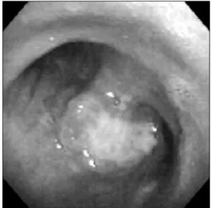 Fig. 3.  Bronchoscopy  shows  the  polypoid  mass  at  subcarina.