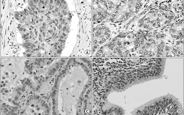 Fig. 2.  Visualization  of  ATG5  expression  in  non-small  cell  lung  cancer  tissues  by  immunohistochemistry