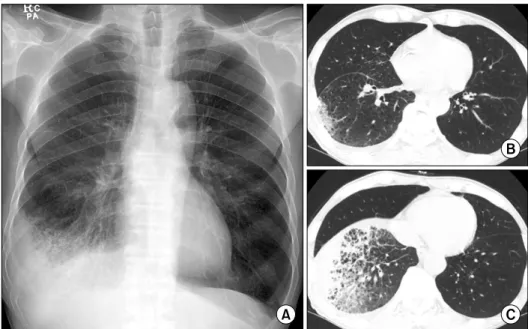 Fig. 1.  (A)  The  chest  X-ray  shows  parenchymal  consolidation  at  the  right  costophrenic  angle  with   pleu-ral  effusion